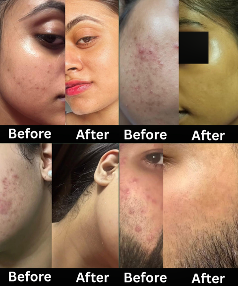 Holistic Acne Healing Kit